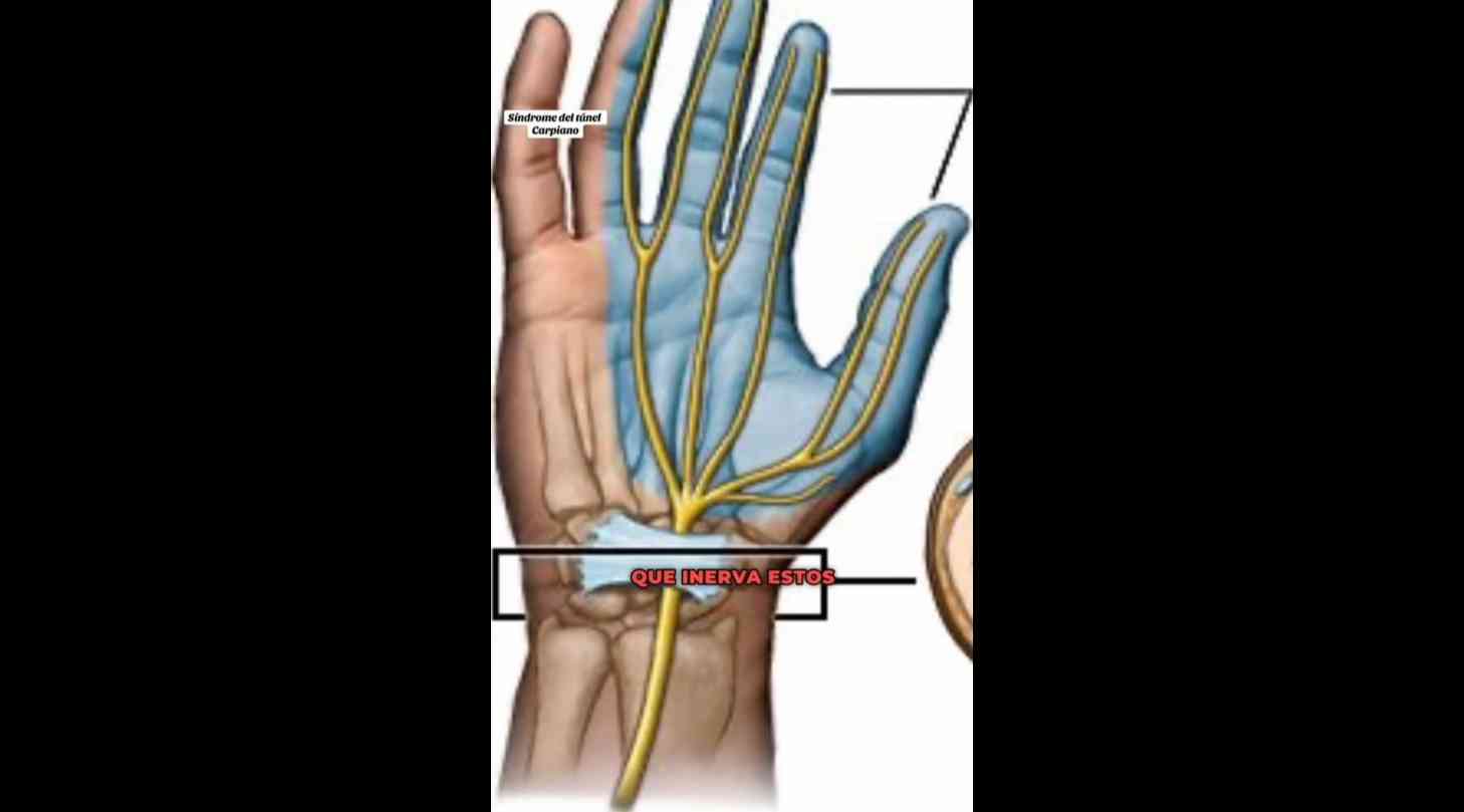 Sindrome del tunel carpiano